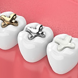 DENTAL FILLING