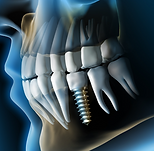 DENTAL IMPLANT