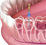 ROOT CANAL-RCT