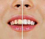 TEETH SCALING AND POLISHING