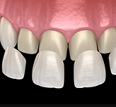 VENEERS
